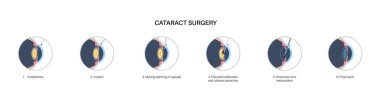 Katarakt ameliyatı. Anestezi, kesi, katarakt çıkarma ve göz içi lens yerleştirme. Vizyon sistemi sorunu ve tedavisi. İnsan gözü hastalığı anatomik poster düz vektör çizimi