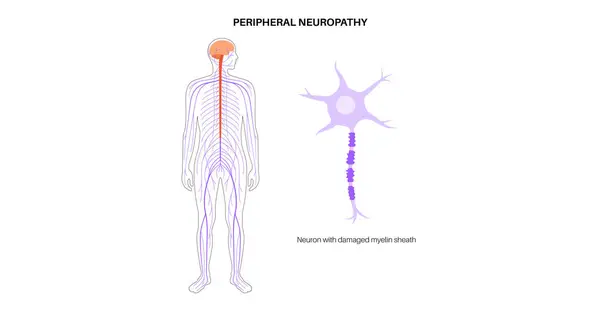 stock vector Peripheral neuropathy poster. Human brain and nerve fiber with a damaged myelin sheath, revealing gaps. Affected areas, indicating impaired signal transmission, pain and weakness vector illustration