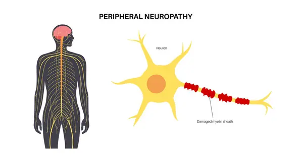 stock vector Peripheral neuropathy poster. Human brain and nerve fiber with a damaged myelin sheath, revealing gaps. Affected areas, indicating impaired signal transmission, pain and weakness vector illustration