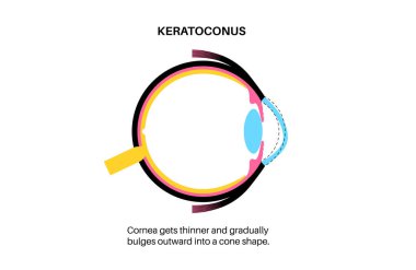 Keratoconus insan gözünün dejenere şekli. Katarakt hastalığı, göz ve göz bebeği anatomisi. Mercek bulanıklığı, görme bozukluğu, körlük. Yaşlanırken görme sorunları. İnsan görme kaybı vektör çizimi