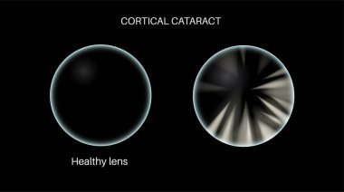 Cortical cataract disease, eye and pupil anatomy. Lens clouding, vision impairment, and potential blindness. Vision problems during aging. Human vision loss concept. Blindness 3D vector illustration clipart