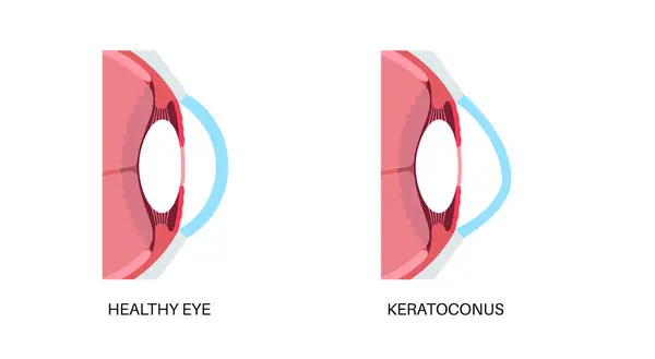 stock vector Keratoconus degenerate shape of human eye. Cataract disease, eye and pupil anatomy. Lens clouding, vision impairment, blindness. Vision problems during aging. Human vision loss vector illustration