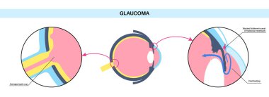 Glaukoma posteri. Artan göz içi basınç, hasarlı optik sinir, görme kaybı. Bulanık görme, görme bozukluğu, ışık ve körlüğün etrafındaki haleler. İnsan gözü hastalığı vektör çizimi.