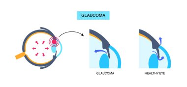 Glaukoma posteri. Artan göz içi basınç, hasarlı optik sinir, görme kaybı. Bulanık görme, görme bozukluğu, ışık ve körlüğün etrafındaki haleler. İnsan gözü hastalığı vektör çizimi.