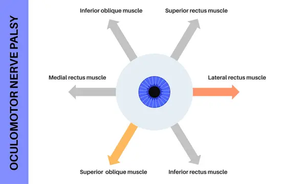 stock vector Oculomotor nerve palsy medical poster. Paralysis of the oculomotor nerve, impaired eye movement, ptosis, and double vision. Diplopia disease. Connection with human brain and eye vector illustration