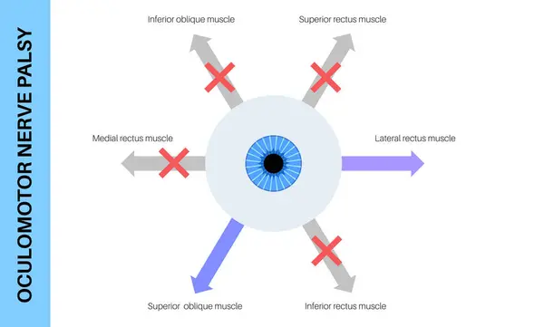 stock vector Oculomotor nerve palsy medical poster. Paralysis of the oculomotor nerve, impaired eye movement, ptosis, and double vision. Diplopia disease. Connection with human brain and eye vector illustration