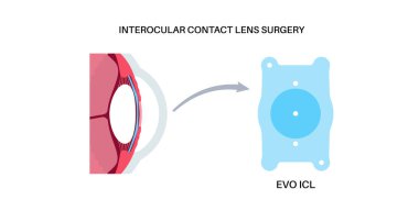 Lens implantation poster. Nearsightedness and astigmatism treatment, healthy eye with minimally invasive procedure EVO ICL. Human visual system anatomy. Cataract surgery flat vector flat illustration clipart