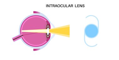 İntraoküler lens yerleştirme posteri. Katarakt tedavisi, IOL ile sağlıklı göz. Miyopluk ya da hipermetropluk. İnsan görsel sistem anatomisi. Katarakt cerrahi anatomik düz vektör çizimi.