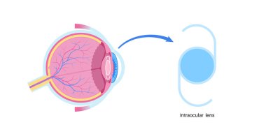 İntraoküler lens yerleştirme posteri. Katarakt tedavisi, IOL ile sağlıklı göz. Miyopluk ya da hipermetropluk. İnsan görsel sistem anatomisi. Katarakt cerrahi anatomik düz vektör çizimi.