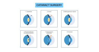 Katarakt ameliyatı. Anestezi, kesi, katarakt çıkarma ve göz içi lens yerleştirme. Vizyon sistemi sorunu ve tedavisi. İnsan gözü hastalığı anatomik poster düz vektör çizimi