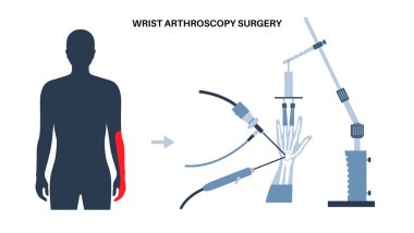 Bilek artroskopisi ameliyatı. Minimum invaziv prosedür. Acı, yaralanma ve insan kolunda iltihap. Artroskop, çekiş kulesi cihazı ve artroskopik alet. El kemiği vektörünün tedavisi