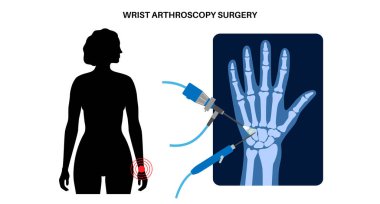Bilek artroskopisi ameliyatı. Minimum invaziv prosedür. Acı, yaralanma ve insan kolunda iltihap. Artroskop ve artroskopik alet. El kemikleri düz vektör medikal illüstrasyon