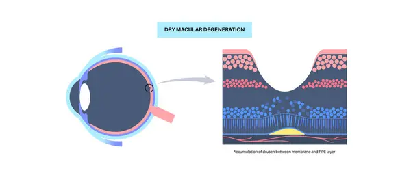 stock vector Dry macular degeneration anatomical poster. Human eye anatomy, retina, macula and fovea structure. Central vision disease diagram. Age related eye problems, visual distortions vector illustration