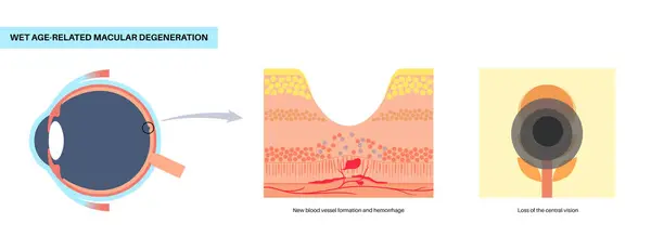 stock vector Wet macular degeneration anatomical poster. Human eye anatomy, retina, macula and fovea structure. Central vision disease diagram. Age related eye problems, abnormal fluid, medical vector illustration