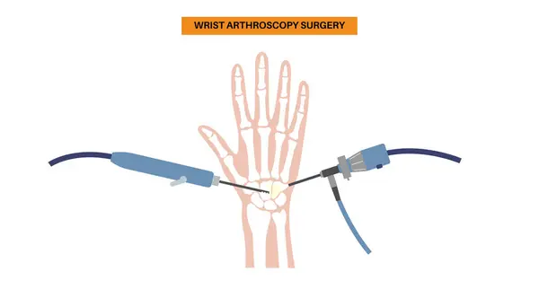 stock vector Wrist arthroscopy surgery. Minimal invasive procedure. Pain, injury and inflammation in the human arm. Arthroscope and arthroscopic instrument. Treatment of hand bones flat vector medical illustration