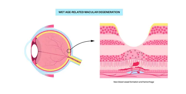 stock vector Wet macular degeneration anatomical poster. Human eye anatomy, retina, macula and fovea structure. Central vision disease diagram. Age related eye problems, abnormal fluid, medical vector illustration