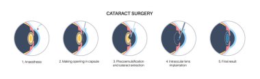 Katarakt ameliyatı. Anestezi, kesi, katarakt çıkarma ve göz içi lens yerleştirme. Vizyon sistemi sorunu ve tedavisi. İnsan gözü hastalığı anatomik poster düz vektör çizimi