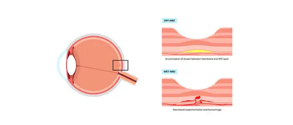 stock vector Wet and dry macular degeneration anatomical poster. Human eye anatomy, retina, macula and fovea structure. Central vision disease diagram. Age related eye problems AMD medical flat vector illustration