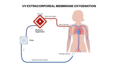 Venovenöz ekstrakporeal zar oksijenlenmesi. VV ECMO konsepti. Extracorporeal yaşam desteği. Geçici mekanik dolaşım desteği. Kadın vücudunda kan dolaşımı düz vektör çizimi