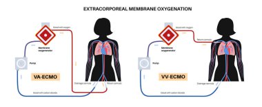 Ekstrakorporeal zar oksijeni. VA ve VV ECMO. Extracorporeal yaşam desteği, kalp akciğer makinesi. Mekanik dolaşım destek sistemi. Kadın vücut vektörü illüstrasyonunda kan dolaşımı