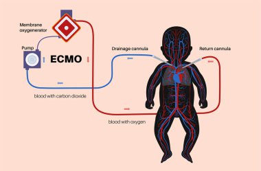 Ekstrakorporeal zar oksijeni. ECMO bebeği. Extracorporeal yaşam desteği, kalp akciğer makinesi. Mekanik dolaşım desteği. İnsan bebek vücudunda kan dolaşımı düz vektör çizimi