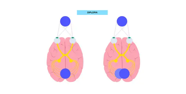 stock vector Diplopia medical poster. Double vision disease, eye muscle weakness or nerve damage. Simultaneous perception of two images of a single object. Connection with human brain and eye vector illustration