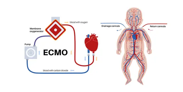 stock vector Extracorporeal membrane oxygenation. ECMO infant. Extracorporeal life support, heart lung machine. Mechanical circulatory support. Blood circulation in the human baby body flat vector illustration