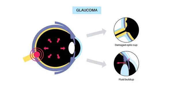 stock vector Glaucoma poster. Increased intraocular pressure, damaged optic nerve, vision loss. Blurry vision, deterioration of eyesight, halos around lights or blindness. Human eye disease vector illustration.