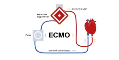 Ekstrakorporeal zar oksijeni. Ekstrakorporeal yaşam desteği, kalp akciğeri ECMO makinesi. Yapay mekanik dolaşım sistemi. İnsan vücudu dışında kan dolaşımı düz vektör çizimi