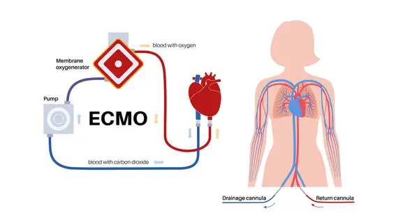 stock vector Extracorporeal membrane oxygenation. Extracorporeal life support, heart lung ECMO machine. Artificial mechanical circulatory system. Blood circulation outside the female human body vector illustration