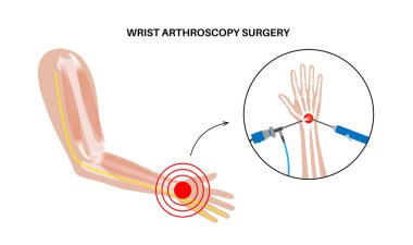 Bilek artroskopisi ameliyatı. Minimum invaziv prosedür. Acı, yaralanma, insan kolunda iltihap. Artroskop ve artroskopik alet. El kemikleri, bağ dokusu, tendonlar ve kas anatomisi vektörü