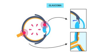Glaukoma posteri. Artan göz içi basınç, hasarlı optik sinir, görme kaybı. Bulanık görme, görme bozukluğu, ışık ve körlüğün etrafındaki haleler. İnsan gözü hastalığı vektör çizimi.