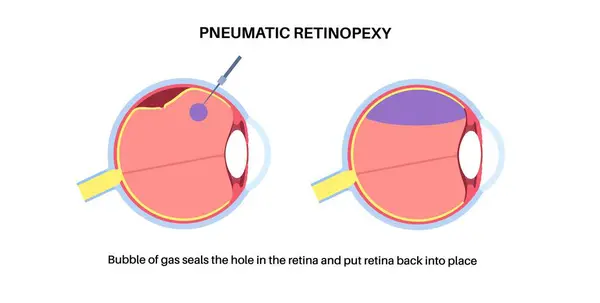 stock vector Pneumatic retinopexy minimally invasive eye procedure. Repair retinal detachment. Injecting gas bubble into the vitreous to reattach the retina, combined with laser or cryotherapy vector illustration