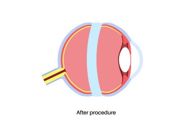 Skleral toka ameliyatı. Retinal çekişi azaltmak için gözün etrafına silikon bant takılarak retina yırtılmasını onarmak için kullanılan prosedür. Görüşün yeniden oluşturulması ve körlük vektör illüstrasyonunun önlenmesi