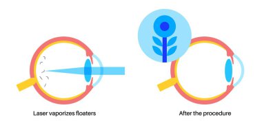 Vitreolysis laser treatment. YAG laser, used in ophthalmology to reduce eye floaters by targeting vitreous opacities. Safe and effective procedure, visual clarity improves, medical vector illustration clipart