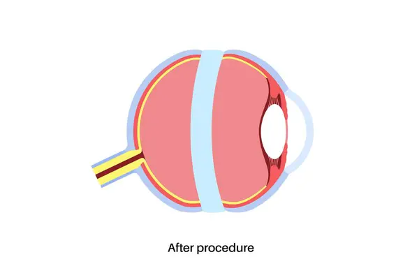 stock vector Scleral buckle surgery. Procedure used to repair retinal detachment by placing a silicone band around the eye to relieve retinal traction. Restoring vision and preventing blindness vector illustration