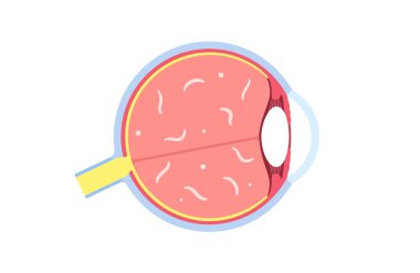 Eye floaters or muscae volitantes poster. Myodesopsias concept, ophthalmology examination. Vitreous humour, gel inside the eyeball. Collagen fibers in the eye. Pupil, retina macula vector illustration clipart