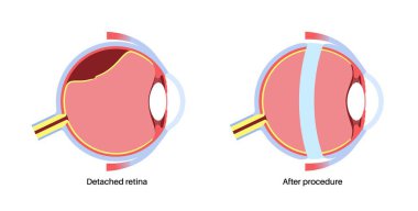 Skleral toka ameliyatı. Retinal çekişi azaltmak için gözün etrafına silikon bant takılarak retina yırtılmasını onarmak için kullanılan prosedür. Görüşün yeniden oluşturulması ve körlük vektör illüstrasyonunun önlenmesi