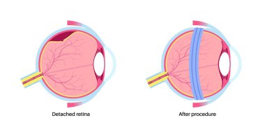 Skleral toka ameliyatı. Retinal çekişi azaltmak için gözün etrafına silikon bant takılarak retina yırtılmasını onarmak için kullanılan prosedür. Görüşün yeniden oluşturulması ve körlük vektör illüstrasyonunun önlenmesi