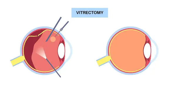 stock vector Vitrectomy surgical procedure. Ophthalmology clinic, remove the vitreous gel from the eye, treating retinal detachment, macular holes, or vitreous hemorrhage, improving vision flat vector illustration