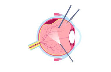 Vitrektomi cerrahi prosedürü. Oftalmoloji kliniği, gözdeki vitröz jeli çıkarın, retina ayrışmasını, maküler delikleri ya da vitroz kanamasını tedavi edin, görme düzlüğü illüstrasyonunu geliştirin