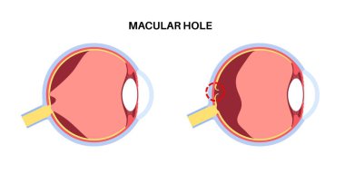 Macula delik göz hastalığı anatomik poster. Yaşla ilgili görme bozukluğu var. Retina ve insan gözü anatomisi. Merkezi görüşü bulanıklaştır. Retina eksikliği tıbbi düz vektör çizimi