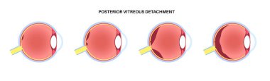 Posterior vitröz ayrışma anatomik posteri. İnsan gözündeki jel retinadan ayrılır. Süzülür ya da ışık yanıp söner. Yaşla ilgili retina sorunları Tıbbi düz vektör çizimi.