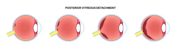 stock vector Posterior vitreous detachment anatomical poster. Gel in the human eyeball separates from the retina. Cause floaters or flashes of light. Age related retina problems medical flat vector illustration.