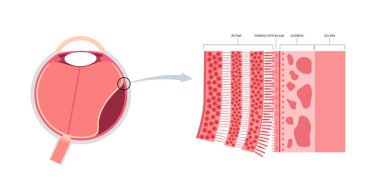 Retinal detachment anatomical poster. Human eye diseases concept, retina tissue problem. Vision loss and blindness, eye floaters and flashes and darkening side vision medical vector illustration. clipart