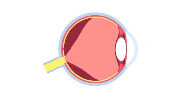 Posterior vitröz ayrışma anatomik posteri. İnsan gözündeki jel retinadan ayrılır. Süzülür ya da ışık yanıp söner. Yaşla ilgili retina sorunları Tıbbi düz vektör çizimi.