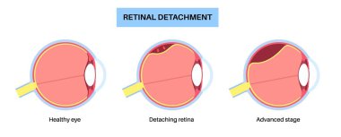 Retina yırtılması anatomik poster. İnsan gözü hastalıkları konsepti, retina dokusu problemi. Görüş kaybı ve körlük, göz süzülüşleri ve parıltılar ve kararan yan görüş tıbbi vektör çizimi.