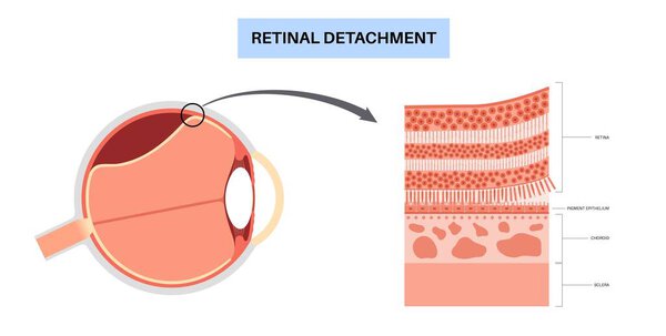 Retinal detachment anatomical poster. Human eye diseases concept, retina tissue problem. Vision loss and blindness, eye floaters and flashes and darkening side vision medical vector illustration.