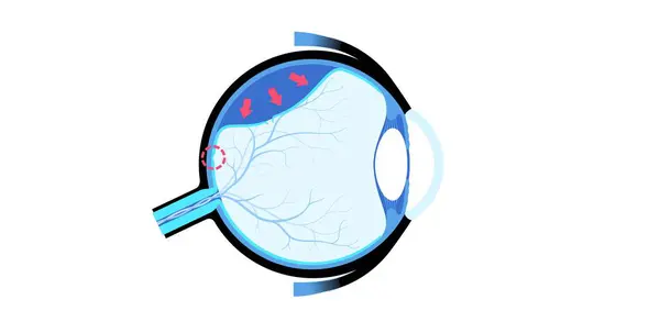 stock vector Retinal detachment anatomical poster. Human eye diseases concept, retina tissue problem. Vision loss and blindness, eye floaters and flashes and darkening side vision medical vector illustration.