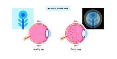 Pigmentosa anatomik posterini yeniden başlatır. İnsan gözü hastalıkları konsepti, retina dokusu problemi. Görme kaybı ve körlük, parlak ışığa duyarlılık ve renk görme kaybı tıbbi vektör çizimi.